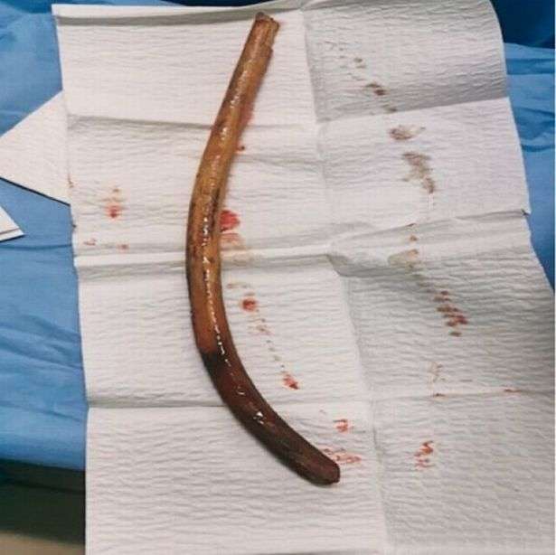 1686719946 0 pay man survives after swallowing a foot long stick