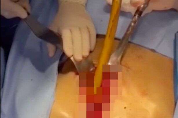 1686719972 1 pay man survives after swallowing a foot long stick